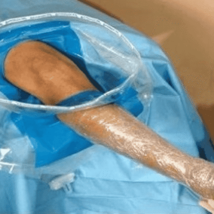 Arthroscopy Drape Eco