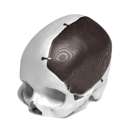 PATIENT SPECIFIC CRANIOPLASTY IMPLANT